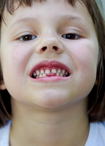 Çocuklarda süt dişleri zannedilenden daha önemli